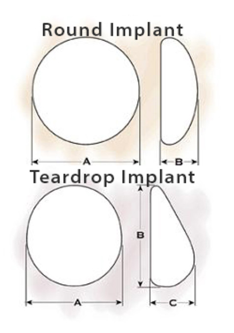 Different Types of Implants