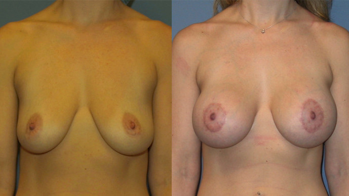 Breast Lift Surgery in Maryland