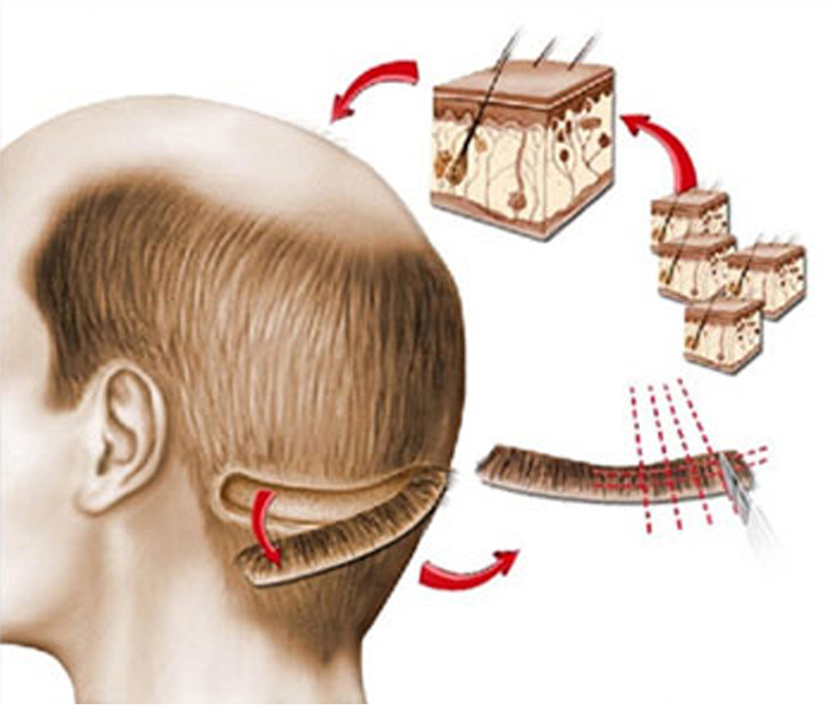 Hair surgery in MD