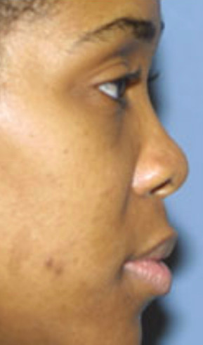 In the time leading up to plastic surgery
