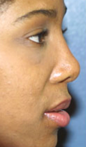 Nose surgeon in Baltimore