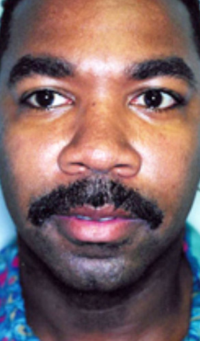 Before Rhinoplasty