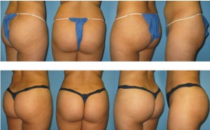 brazilian butt lift before and after image