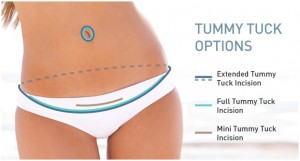 Dr. Trussler Liposuction Surgeon Austin