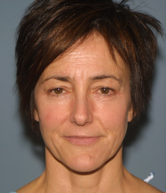 Blepharoplasty patient, before surgery