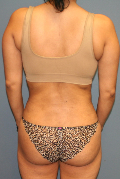 image of a woman's butt after a Brazilian butt lift