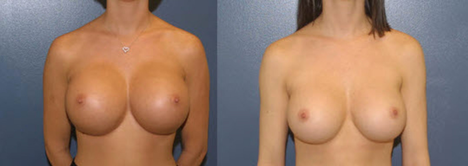 An example of breast implants that are too big for the patient