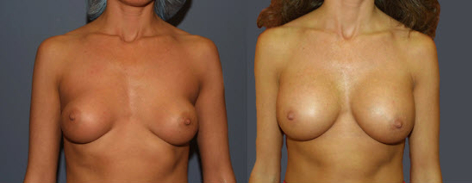 An example of breast implants that are too small for the patient
