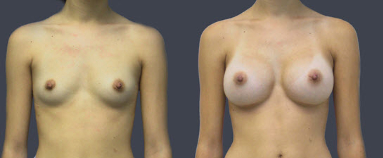 An example of a patient with breast implants that are just right for her frame.
