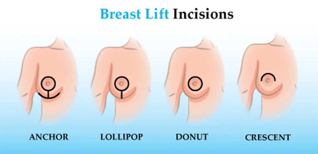a graphic showing the different types of breast lift incisions