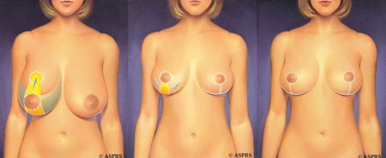A graphic showing how a wise pattern breast reduction works.