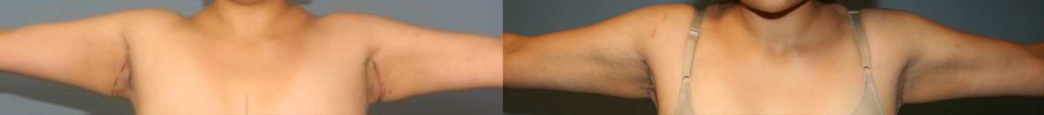 An example of short scar brachioplasty for a weight loss patient