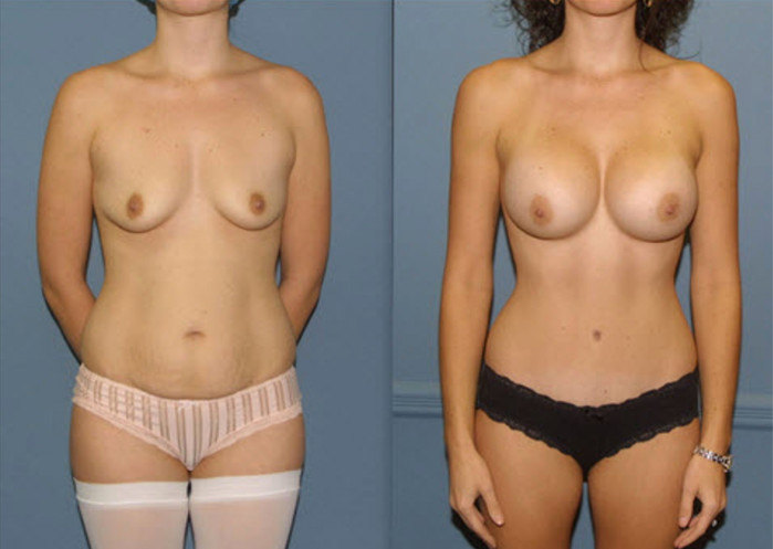 Before and after images of a mommy makeover