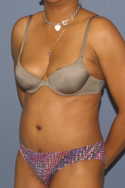 Tummy tuck surgery in MD