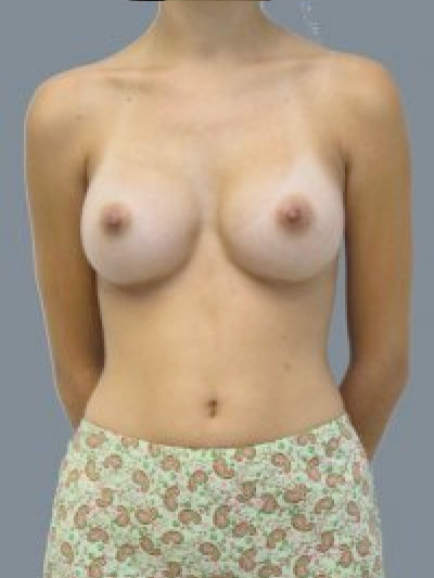 After breast augmentation in Maryland