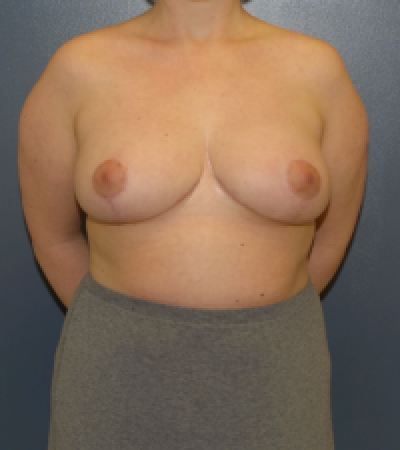 Breast reduction surgery in DC