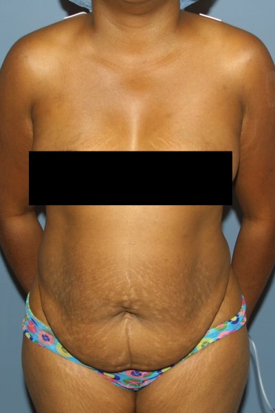 Tummy Tuck Before & After Photos