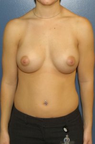 After the submuscular implant