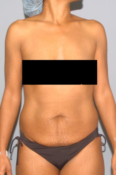 Full Tummy Tuck After C-Section 39-Year-Old Patient Left Profile Photos -  Tummy Tuck Before and After - DeLuca Plastic Surgery