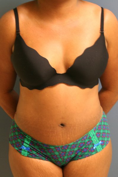 Top tummy tuck in Washington