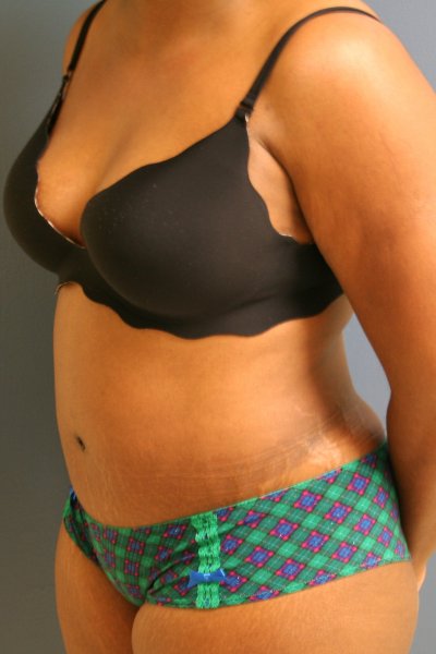 Top tummy tuck in DC