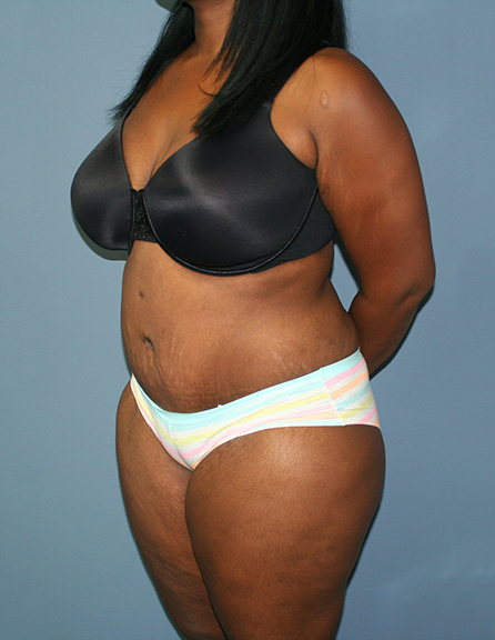 Extended abdominoplasty in Maryland