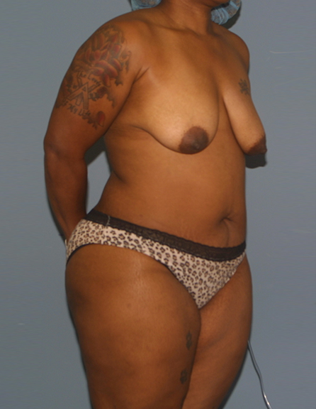 Before the surgery