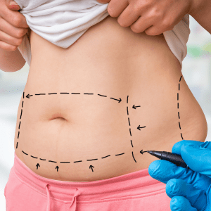 Why you should get a quilted tummy tuck