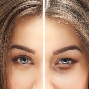 Eyelid Surgery vs Brow Lift