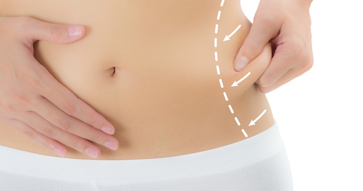 If Liposuction Makes Sense for You