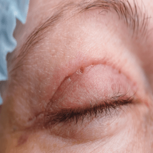 upper eyelid surgery