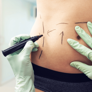 vibration-supported liposuction what to expect