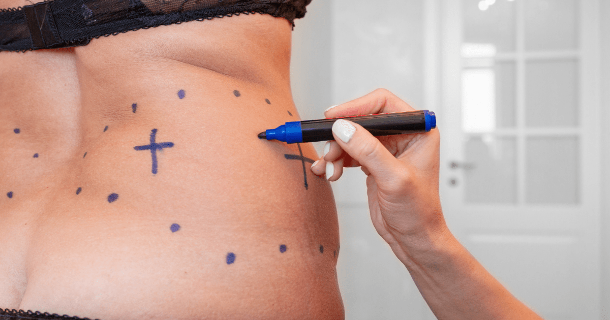 Will Lower Back Liposuction Also Address The Flanks?