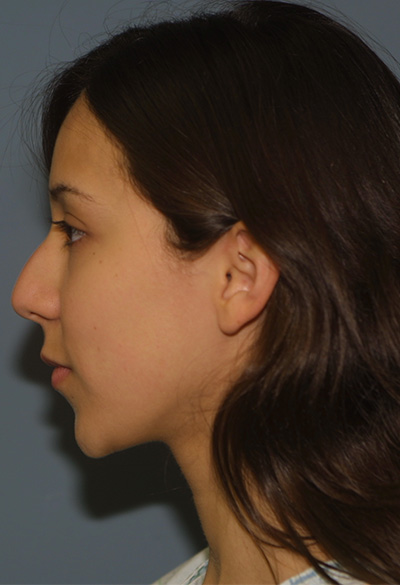 before rhinoplasty (nose job) left side profile