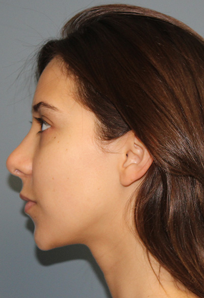 after rhinoplasty (nose job) left side profile