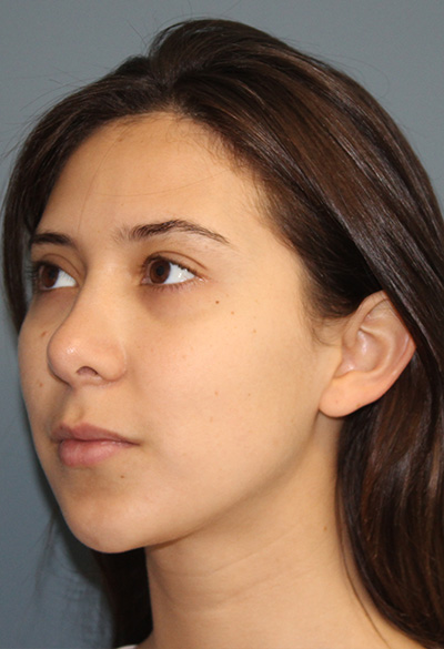 after rhinoplasty (nose job) left side