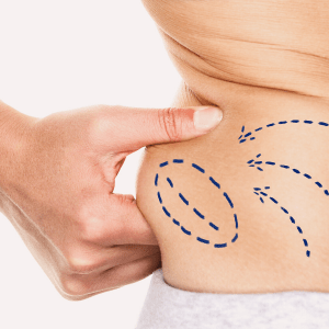 liposuction in maryland 