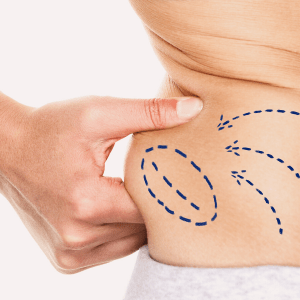 liposuction in maryland