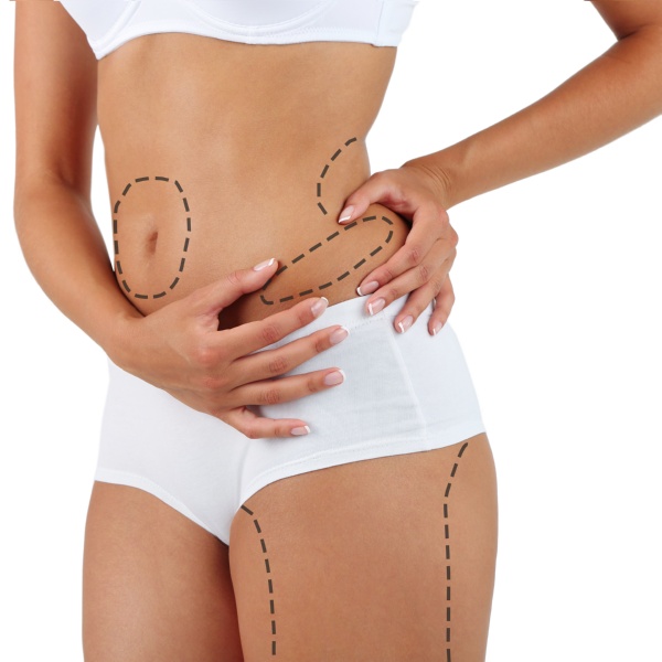 liposuction procedure