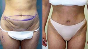 before and after photo of a tummy tuck patient
