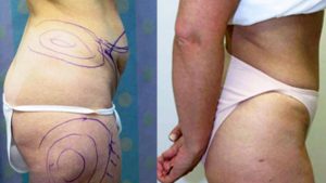 before and after photo of a tummy tuck patient