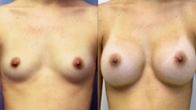 before and after picture of breast augmentation