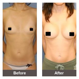 Breast Augmentation Gallery