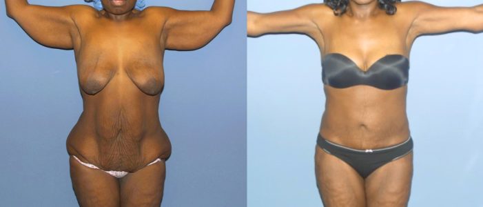 An example of a patient who has undergone surgery after massive weight loss