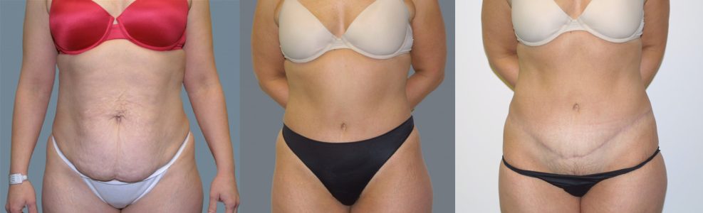 Post Weight Loss Surgery Example