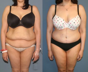 Post Weight Loss Surgery Example