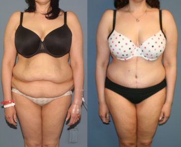 Post Weight Loss Surgery Example Post Weight Loss Surgery Example