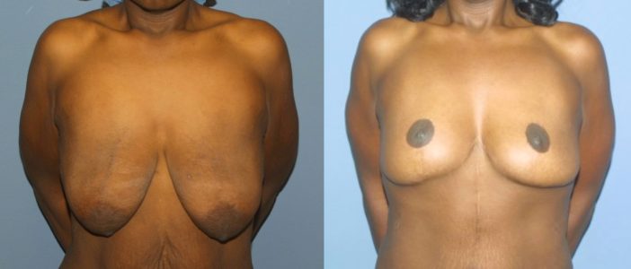 An example of a patient who has undergone surgery after massive weight loss