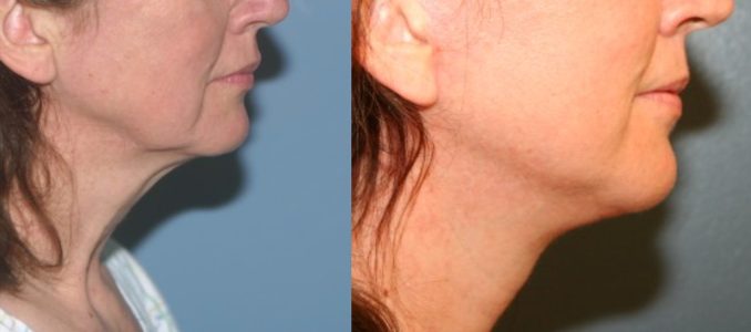 A patient that had a facelift after massive weight loss