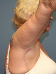 A side profile picture of a patient after undergoing an extended brachioplasty after significant weight loss